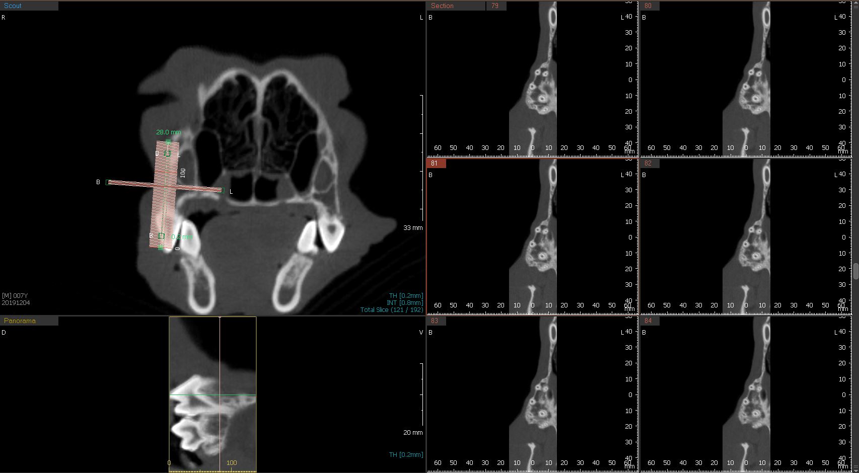 Dental Root