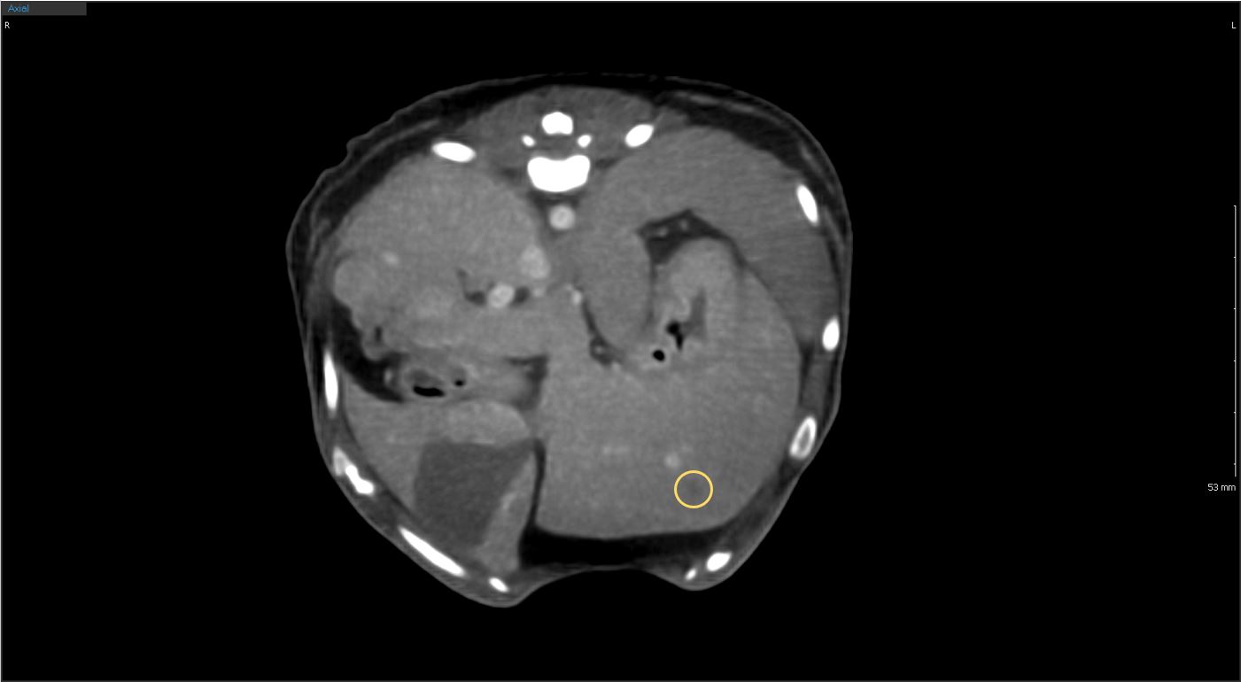 Hepatic nodule