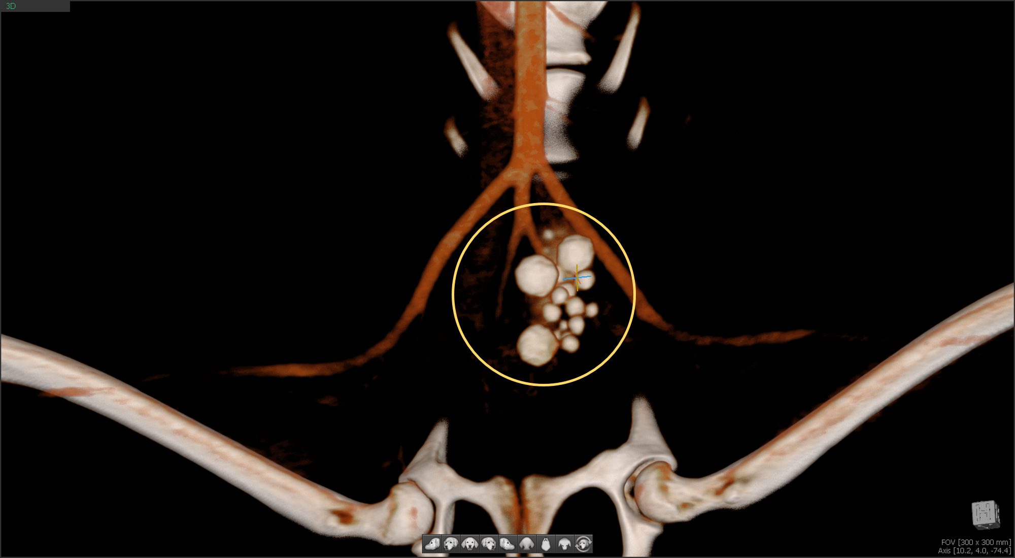 Bladder calculus