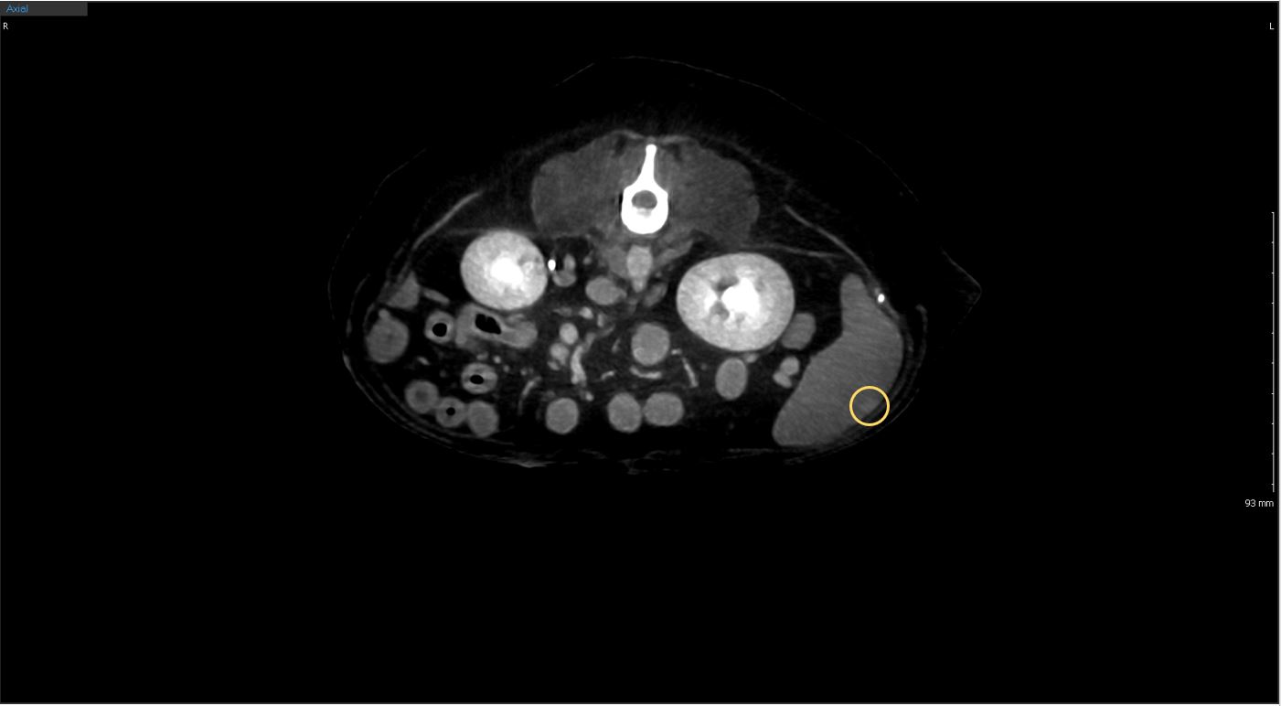 Splenic nodule