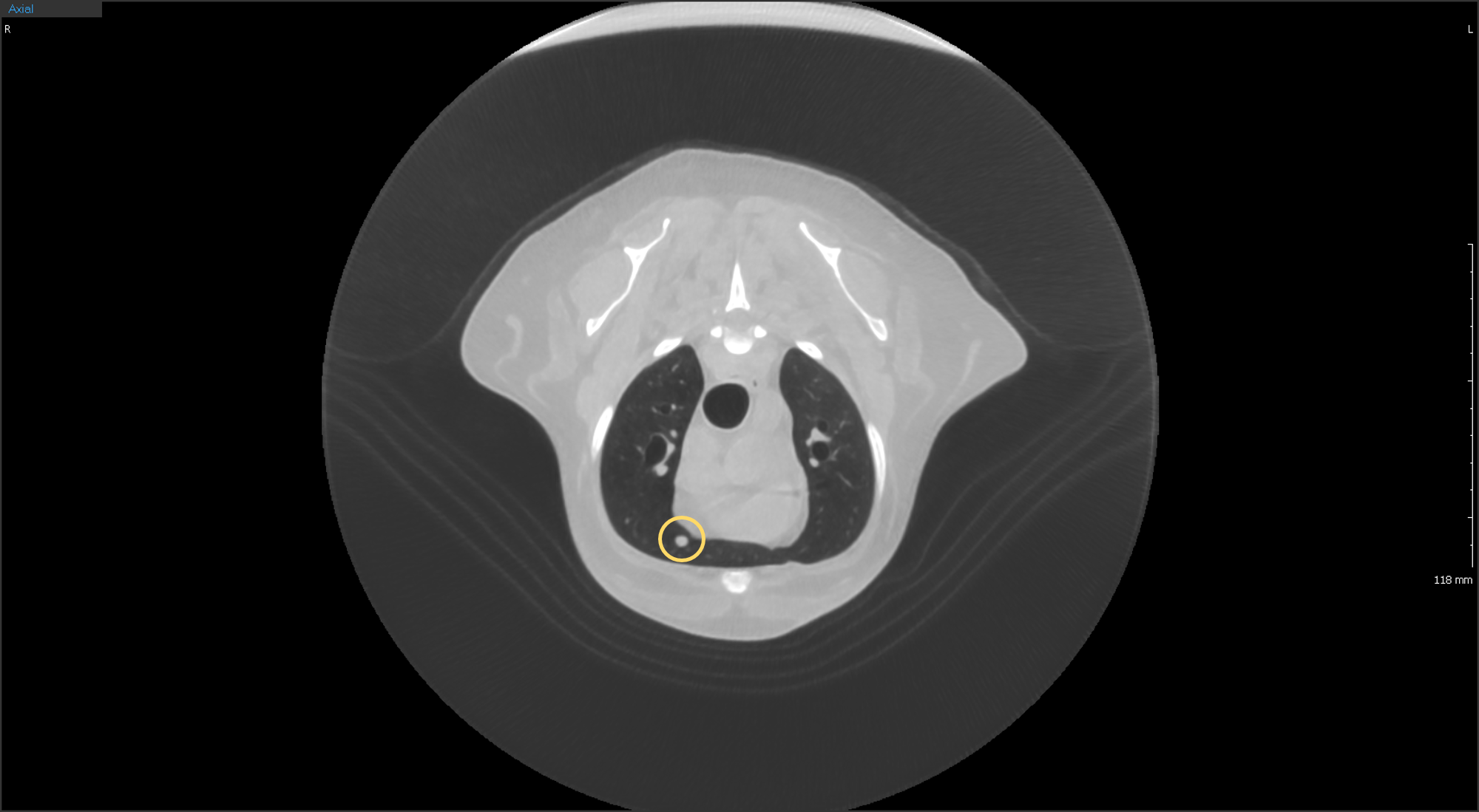 Lung nodule